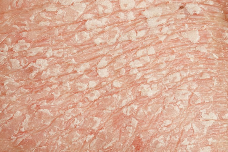 Psoriasis vulgaris 